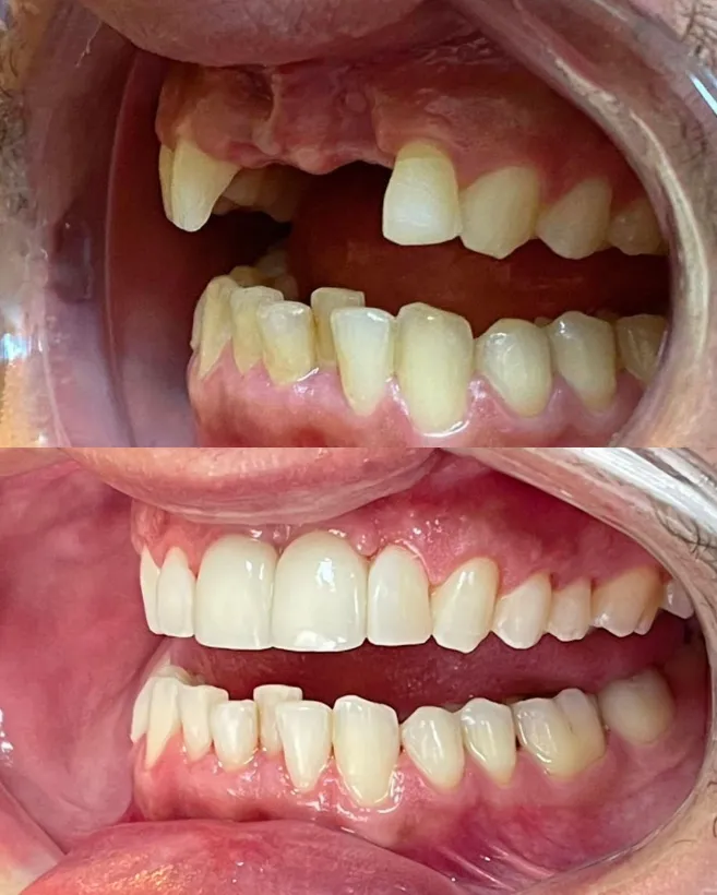 Antes e depois de implante dentário na Humanized